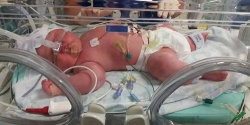 Bayi Thomas saat di inkubator.(mirror.co.uk)