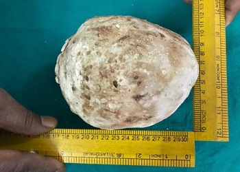 Batu seberat 1,4 kg yang berhasil dikeluarkan.(metro.co.uk)