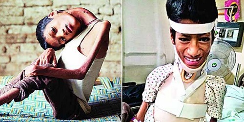 Mahendra Ahirwar, sebelum & sesudah operasi.(dnaindia)