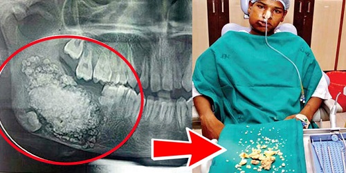 Ashik Garai dan gigi yang berhasil dikeluarkan.(tinvuila)