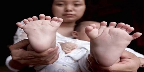 Hong Kong, bayi pemilik 31 jari.(Youtube)